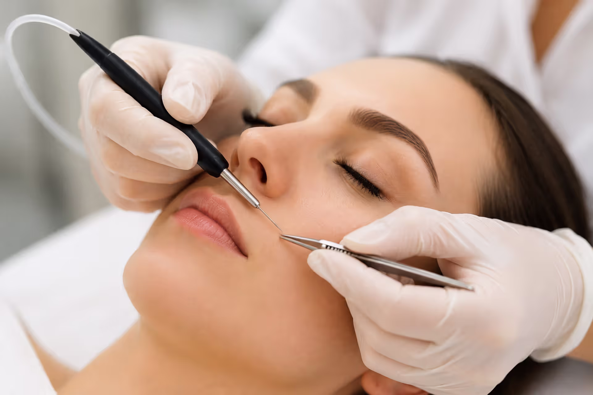 Professional Electrolysis Hair Removal Treatment in Modern Aesthetic Clinic